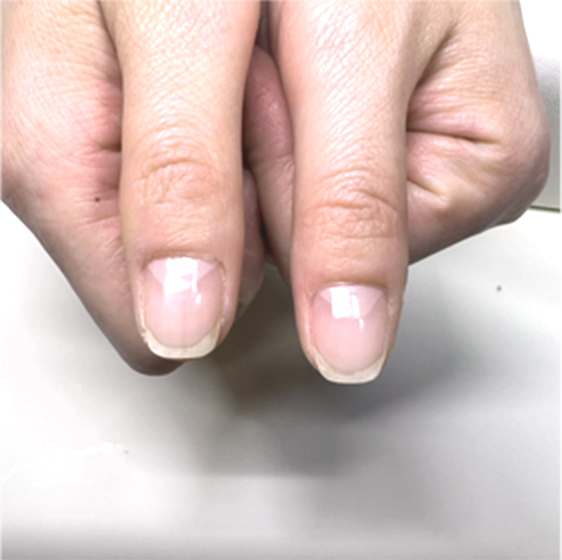 噛み爪ビフォーアフター