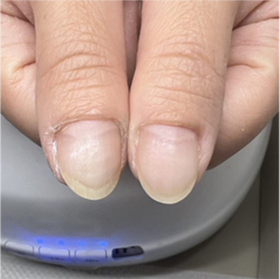 噛み爪ビフォーアフター