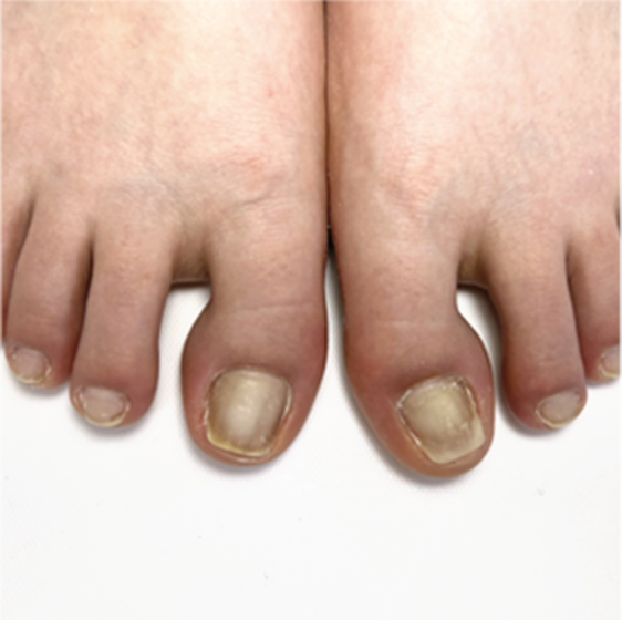 足自爪育成ビフォーアフター