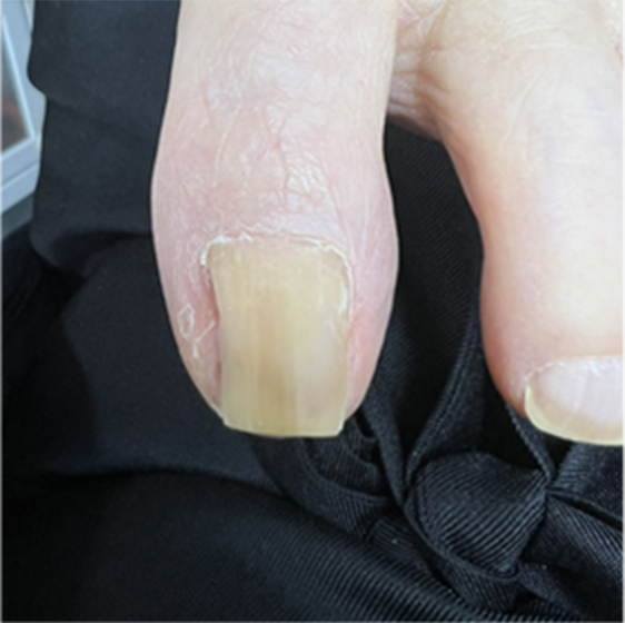 巻き爪育成ビフォーアフター