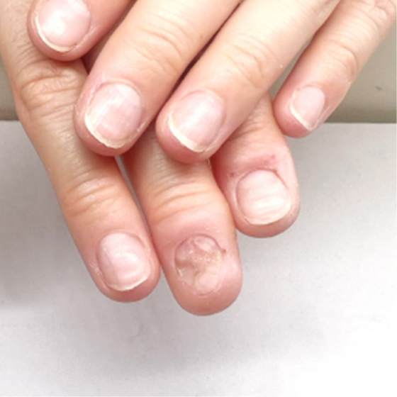 自爪育成ビフォーアフター