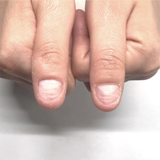 噛み爪ビフォーアフター