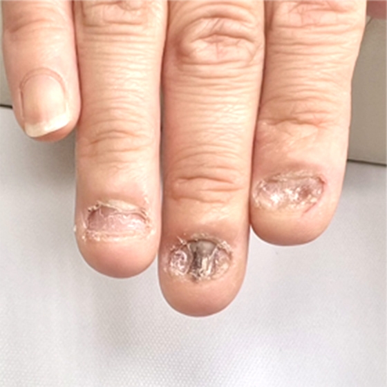 自爪育成ビフォーアフター