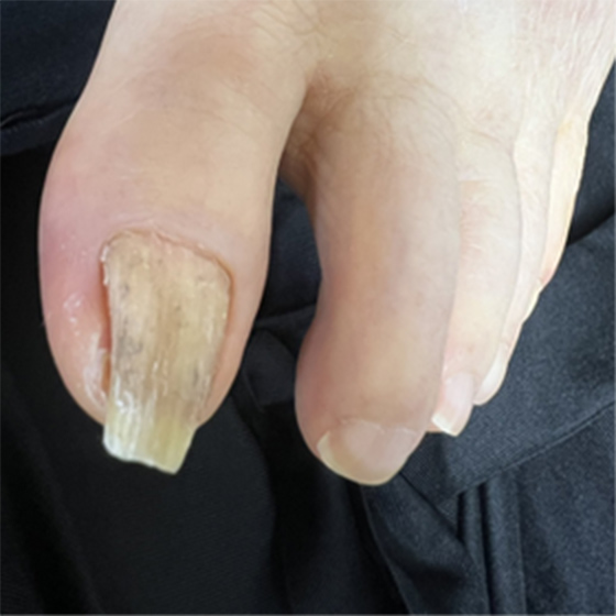 巻き爪育成ビフォーアフター